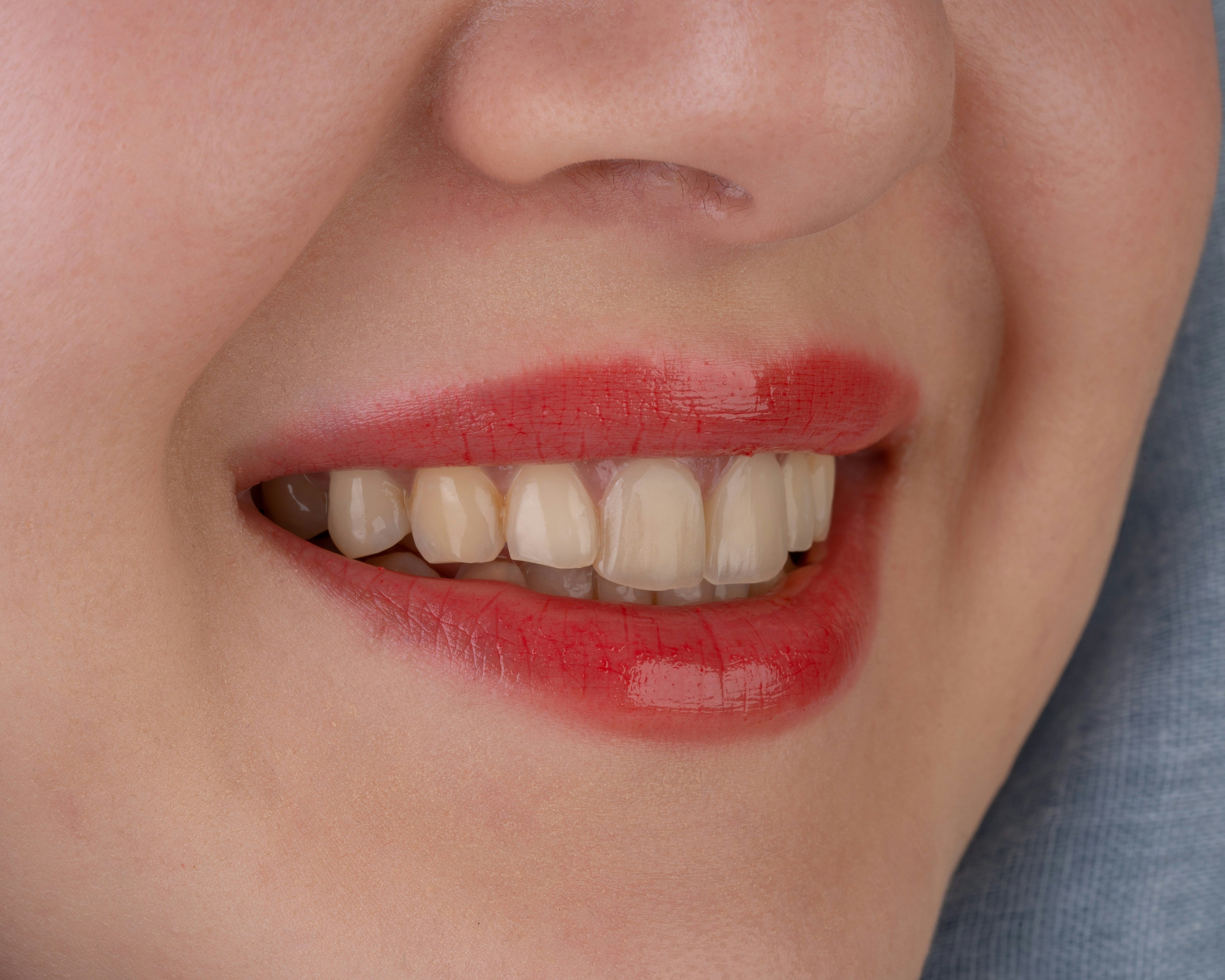 Global Dental Veneer News Summary: Material Innovation , May 2026 Highlights