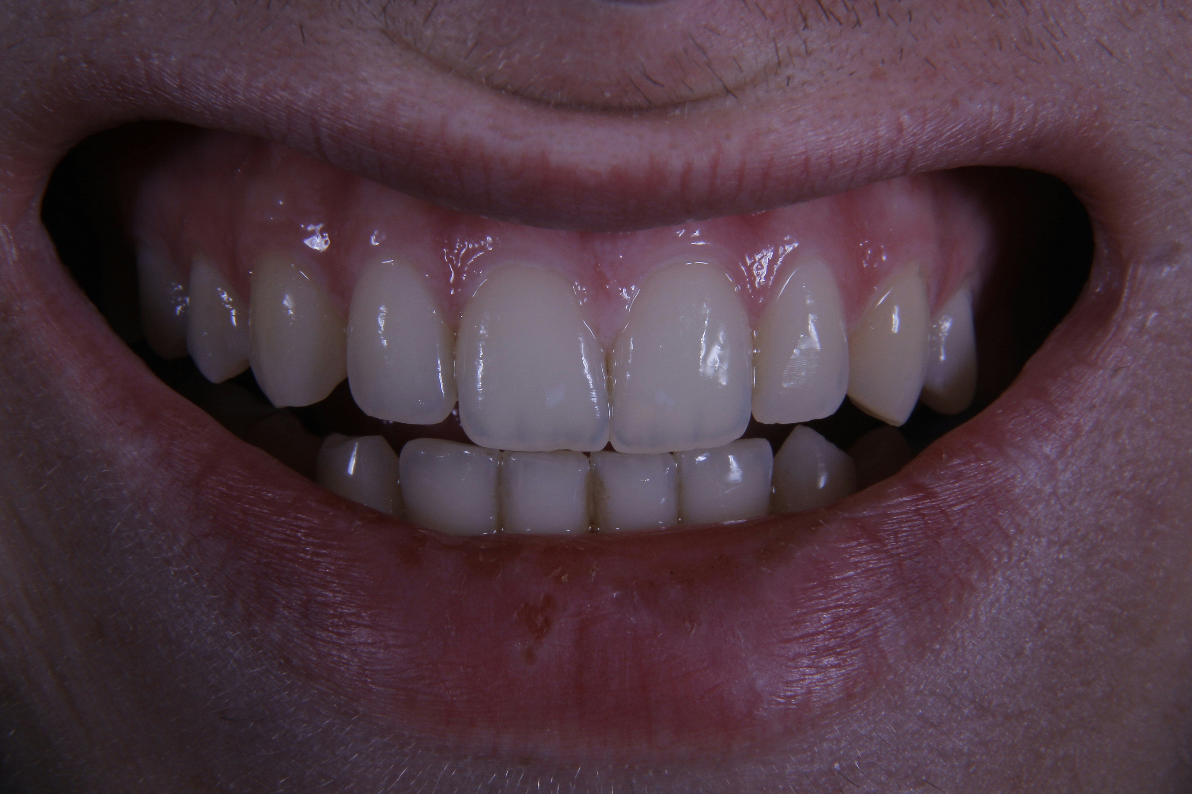 Summer 2026 After Implant Surgery: A Survival Guide for Your New Bone