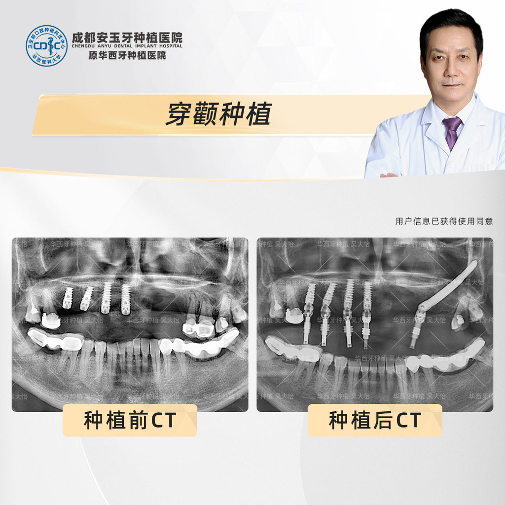 Zygomatic Implant  (Zygoma Implants) Clinical Cases: Professor Wu Dayi