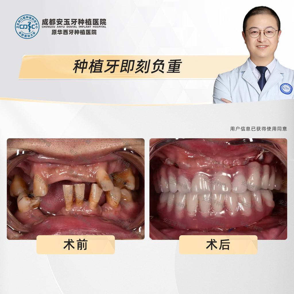 Full-Mouth Dental Implants  Clinical Cases: Dr. Ling Xiongjian