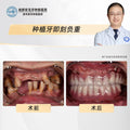 Full-Mouth Dental Implants  Clinical Cases: Dr. Ling Xiongjian