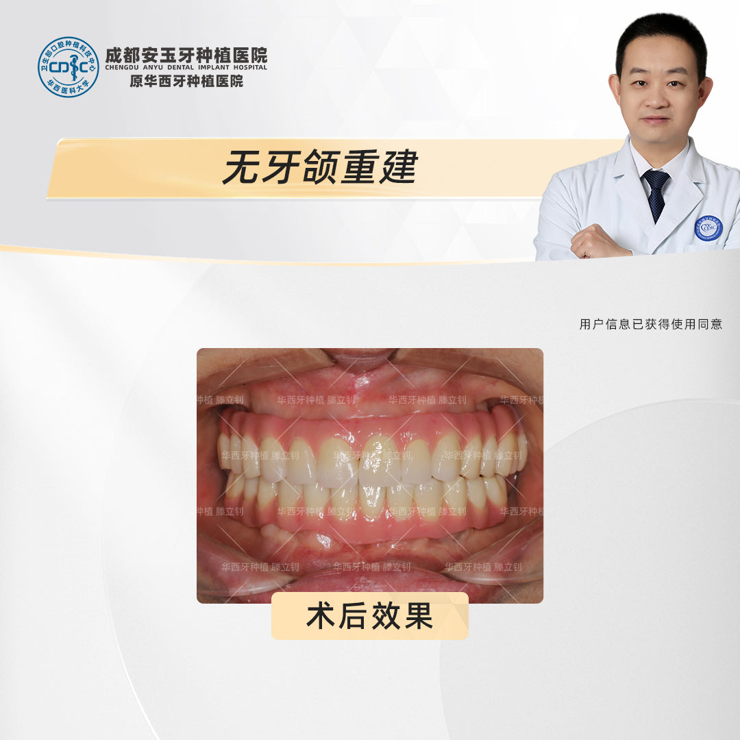 Full Mouth Dental Implants, Edentulous Reconstruction with All-on-6, Clinical Cases: Dr. Teng Lizhao