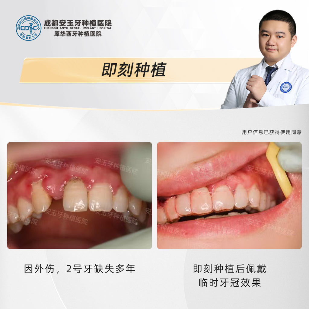Dental Implant, Single Tooth Implant with Immediate Placement and Bone Grafting, Clinical Cases: Dr. Tang Caomin