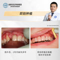 Dental Implant, Single Tooth Implant with Immediate Placement and Bone Grafting, Clinical Cases: Dr. Tang Caomin