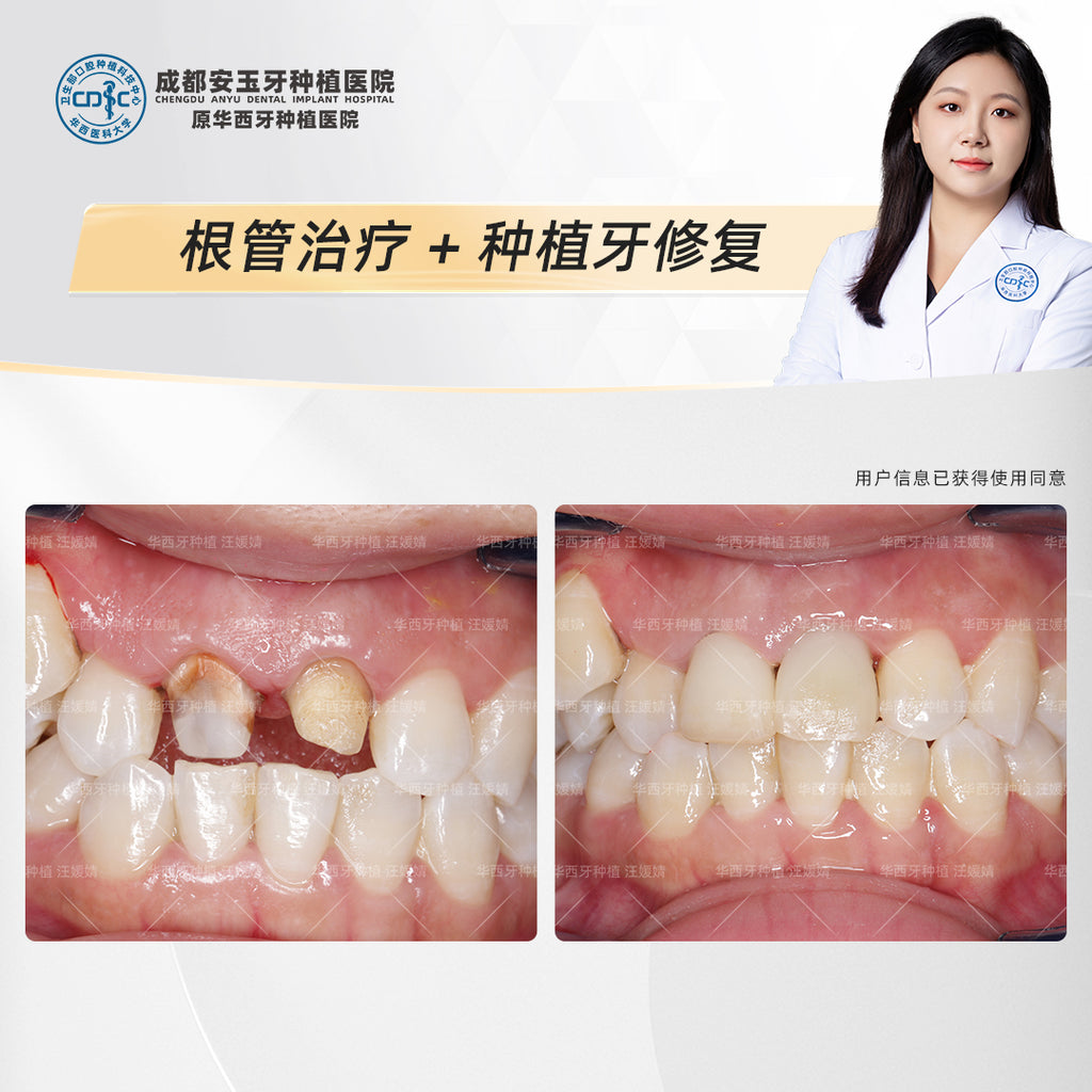 Dental Implant & Root Canal Therapy,A Combined Restorative Approach, Clinical Cases: Dr. Wang Yuanjing