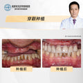 Zygomatic Implant  (Zygoma Implants) Clinical Cases: Professor Wu Dayi