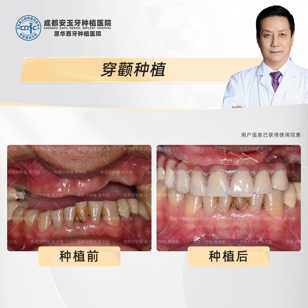 Zygomatic Implant  (Zygoma Implants) Clinical Cases: Professor Wu Dayi