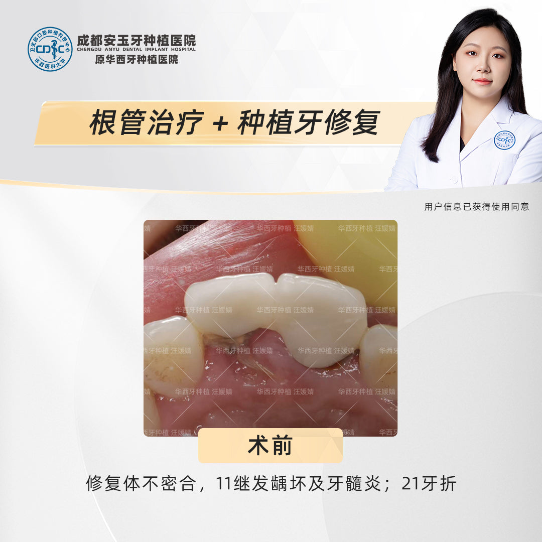 Dental Implant & Root Canal Therapy,A Combined Restorative Approach, Clinical Cases: Dr. Wang Yuanjing