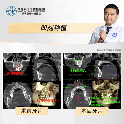 Dental Implant, Single Tooth Implant with Immediate Placement and Bone Grafting, Clinical Cases: Dr. Tang Caomin