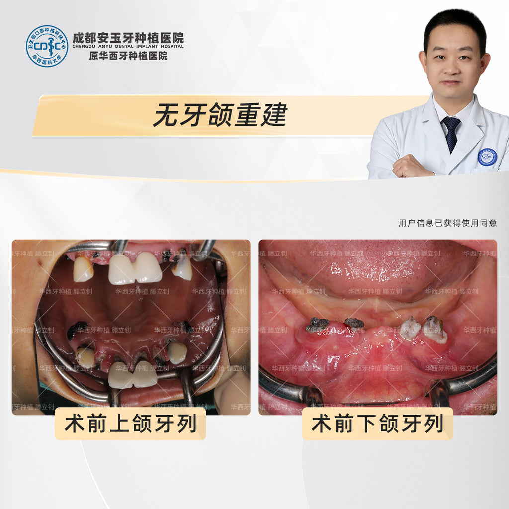Full Mouth Dental Implants, Edentulous Reconstruction with All-on-6, Clinical Cases: Dr. Teng Lizhao