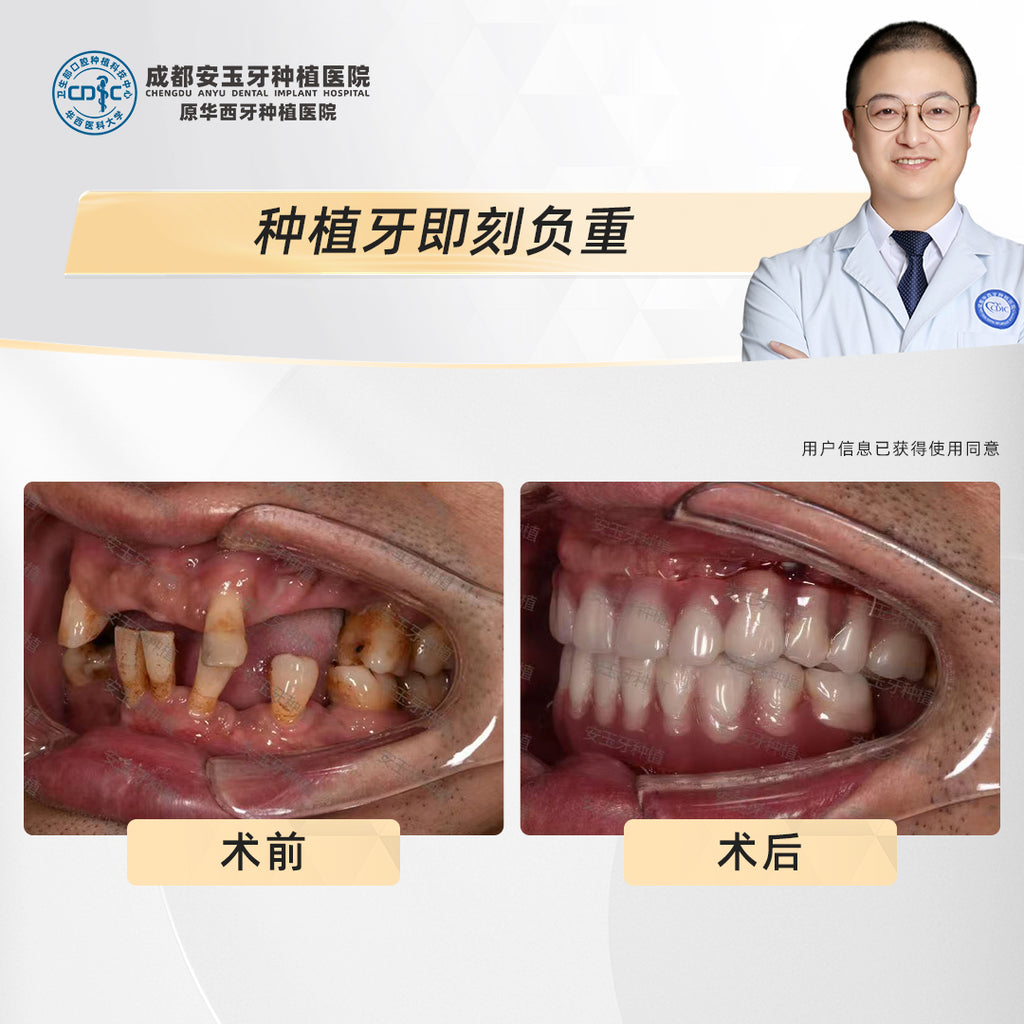 Full-Mouth Dental Implants  Clinical Cases: Dr. Ling Xiongjian