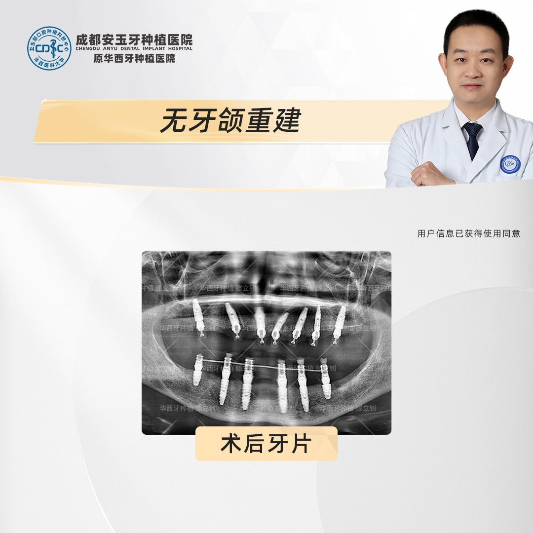 Full Mouth Dental Implants, Edentulous Reconstruction with All-on-6, Clinical Cases: Dr. Teng Lizhao