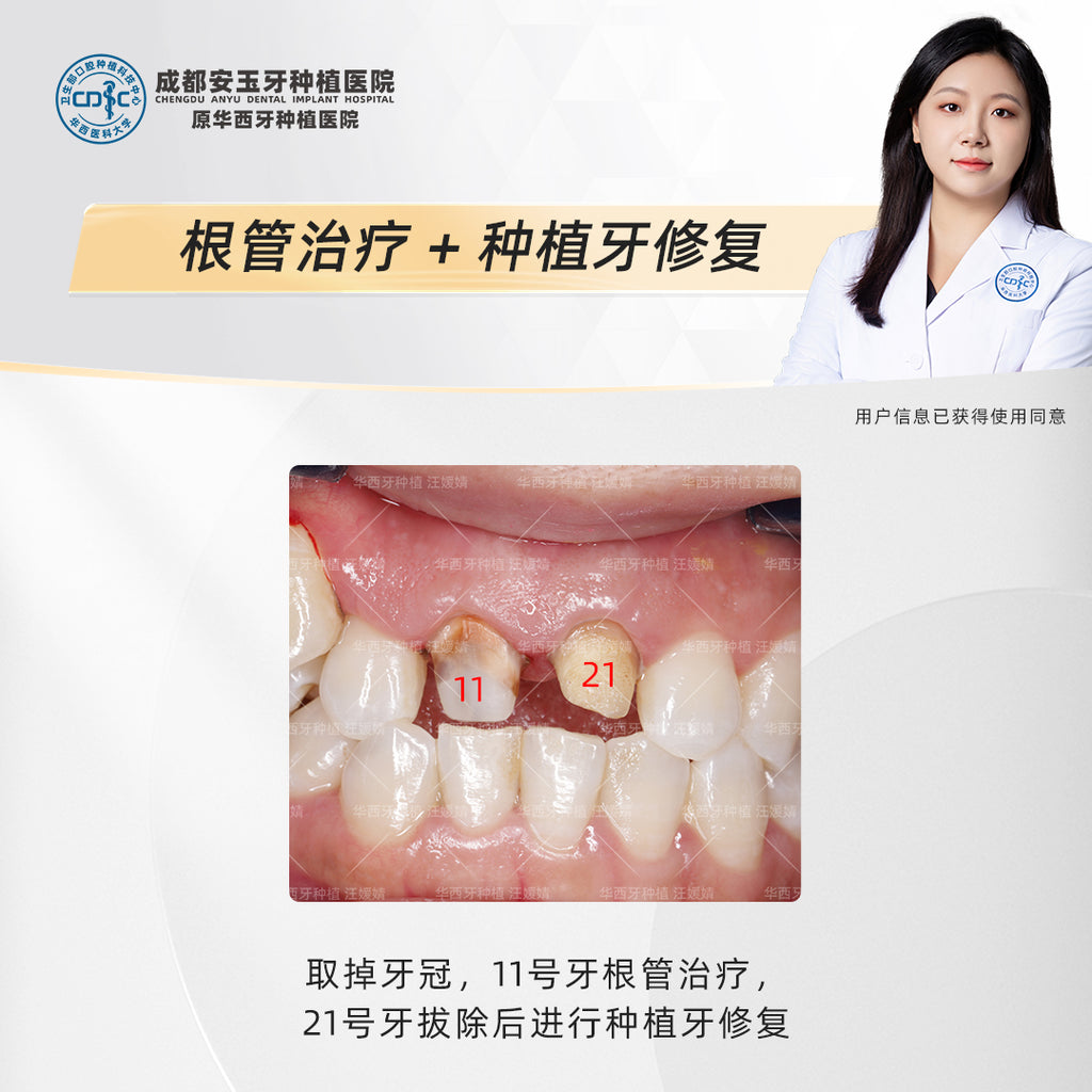 Dental Implant & Root Canal Therapy,A Combined Restorative Approach, Clinical Cases: Dr. Wang Yuanjing