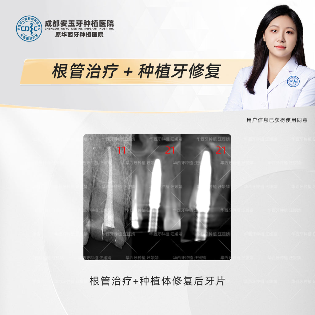 Dental Implant & Root Canal Therapy,A Combined Restorative Approach, Clinical Cases: Dr. Wang Yuanjing