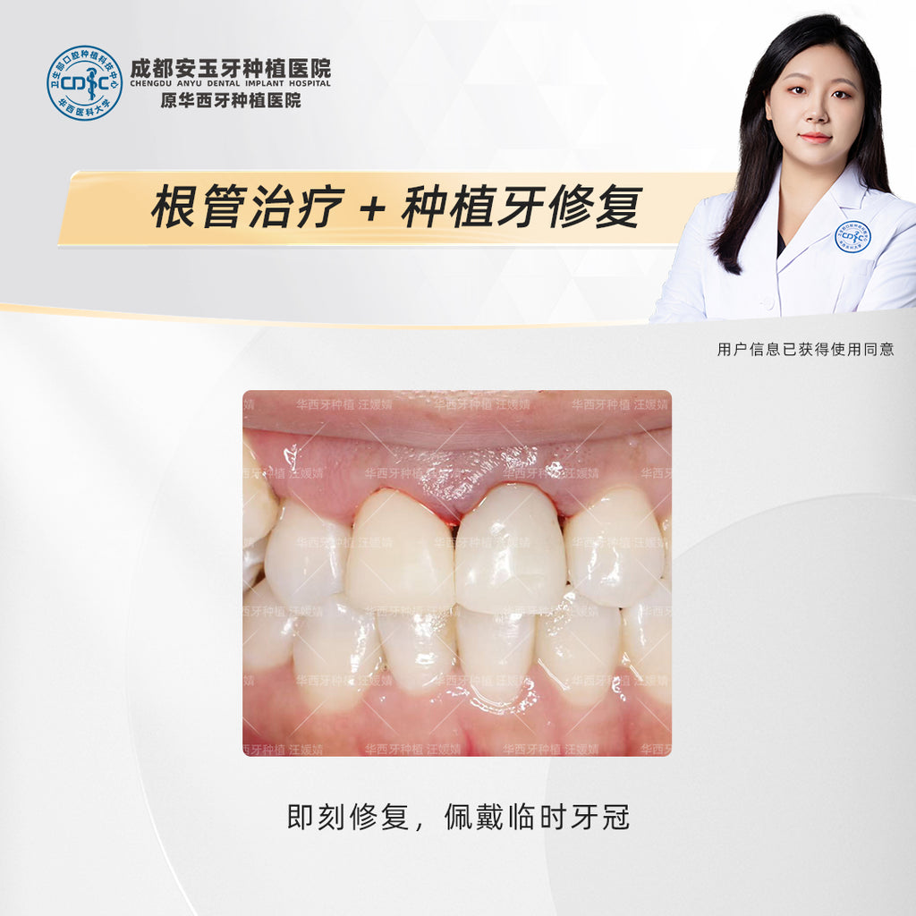 Dental Implant & Root Canal Therapy,A Combined Restorative Approach, Clinical Cases: Dr. Wang Yuanjing