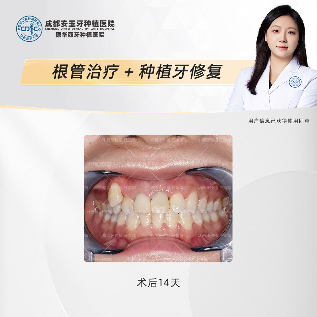 Dental Implant & Root Canal Therapy,A Combined Restorative Approach, Clinical Cases: Dr. Wang Yuanjing