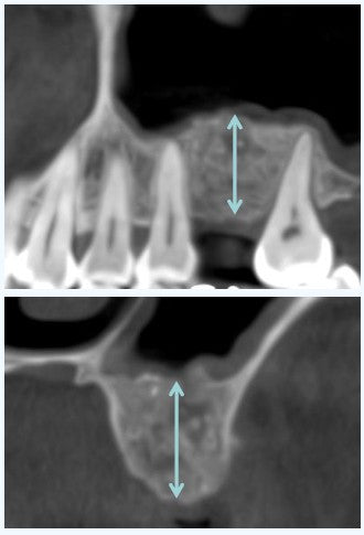 CBCT review at 10 months postoperatively showing residual bone height increased to approximately 12.0 mm