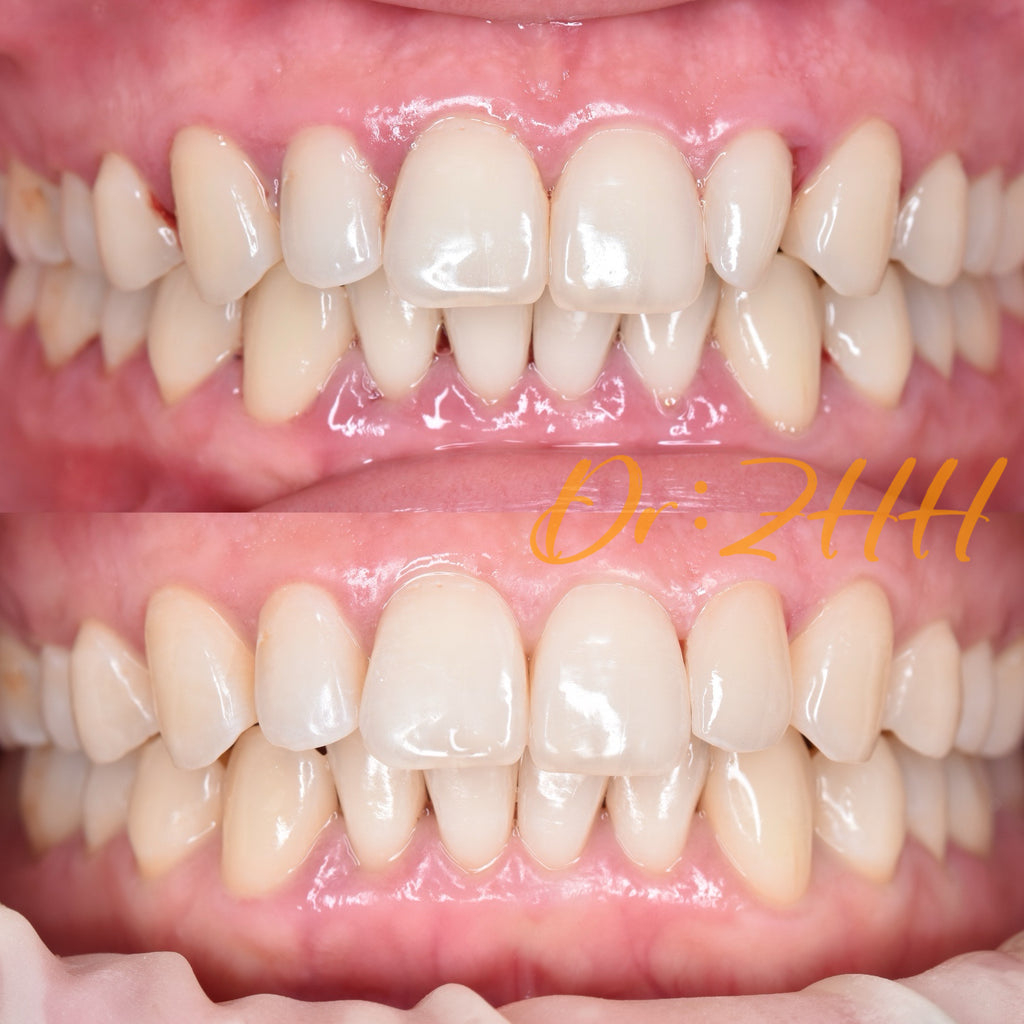 Dental Veneers + Smile Curve Design, Clinical Cases: Dr. Zhang Huihui