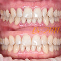 Dental Veneers + Smile Curve Design, Clinical Cases: Dr. Zhang Huihui