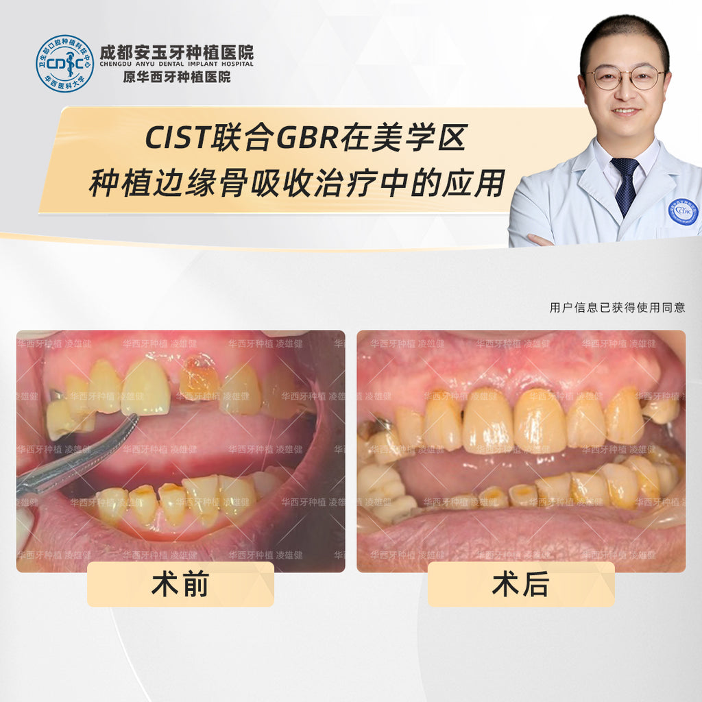 Dental Implants, Fixing Bone Loss with Deep Cleaning and Bone Grafting, Clinical Cases: Dr. Ling Xiongjian