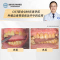 Dental Implants, Fixing Bone Loss with Deep Cleaning and Bone Grafting, Clinical Cases: Dr. Ling Xiongjian