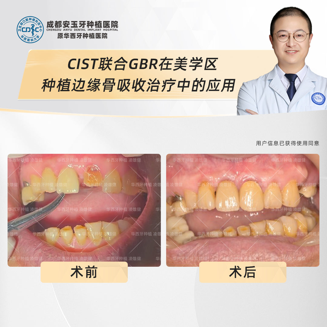 Dental Implants, Fixing Bone Loss with Deep Cleaning and Bone Grafting, Clinical Cases: Dr. Ling Xiongjian