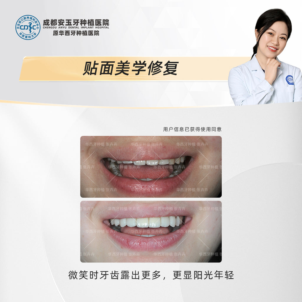 Dental Veneers: Aesthetic Rehabilitation for a Radiant Smile, Clinical Cases: Dr. Zhang Huihui