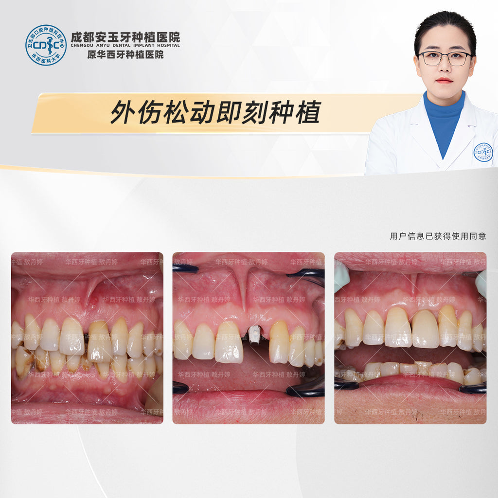 Immediate Dental Implant Therapy, Restoring Function and Aesthetics, Clinical Cases: Dr.&nbsp;Ao Danting