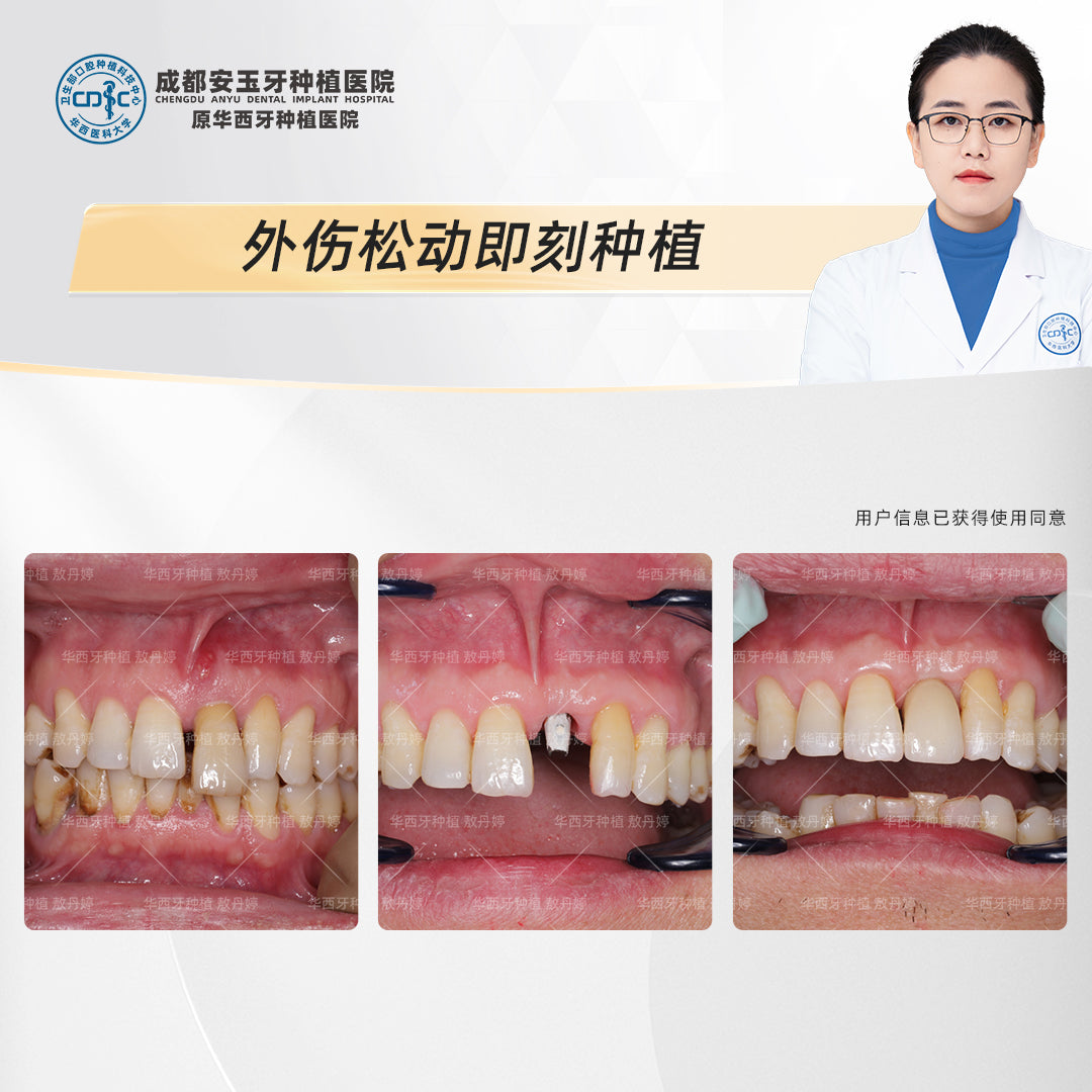 Immediate Dental Implant Therapy, Restoring Function and Aesthetics, Clinical Cases: Dr.&nbsp;Ao Danting