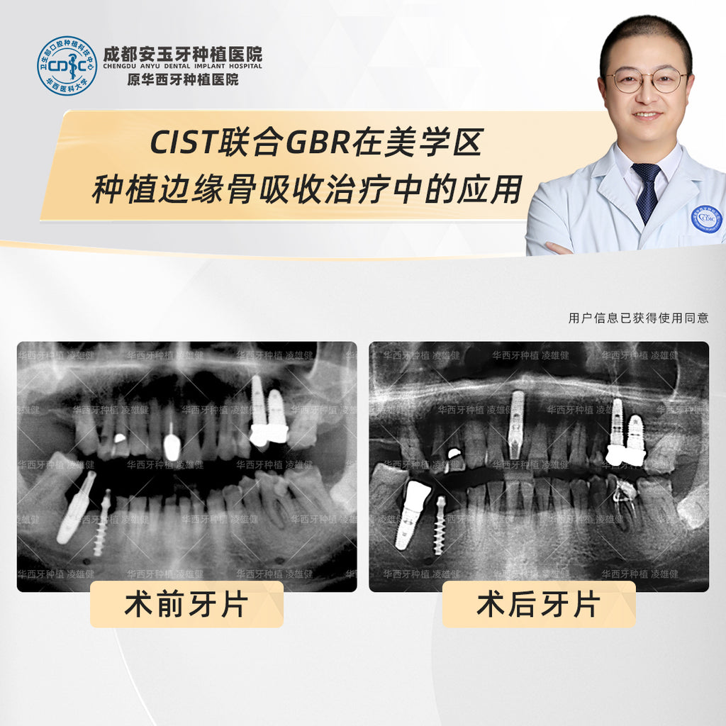 Dental Implants, Fixing Bone Loss with Deep Cleaning and Bone Grafting, Clinical Cases: Dr. Ling Xiongjian