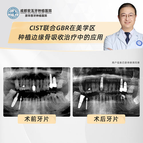 Dental Implants, Fixing Bone Loss with Deep Cleaning and Bone Grafting, Clinical Cases: Dr. Ling Xiongjian