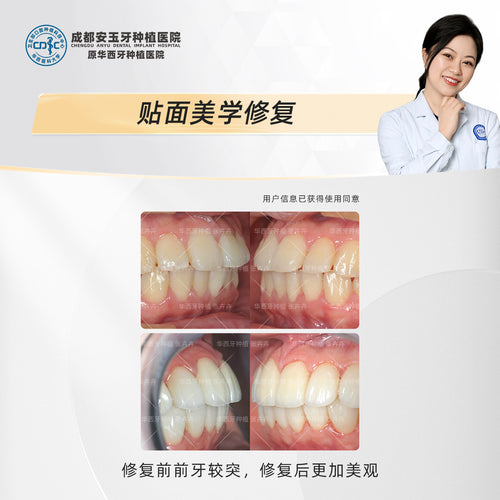Dental Veneers: Aesthetic Rehabilitation for a Radiant Smile, Clinical Cases: Dr. Zhang Huihui
