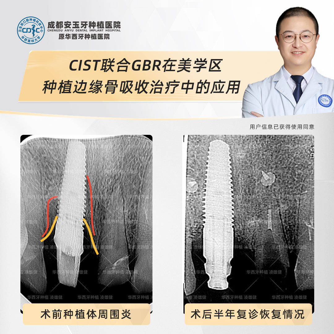 Dental Implants, Fixing Bone Loss with Deep Cleaning and Bone Grafting, Clinical Cases: Dr. Ling Xiongjian