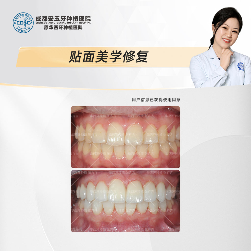 Dental Veneers: Aesthetic Rehabilitation for a Radiant Smile, Clinical Cases: Dr. Zhang Huihui