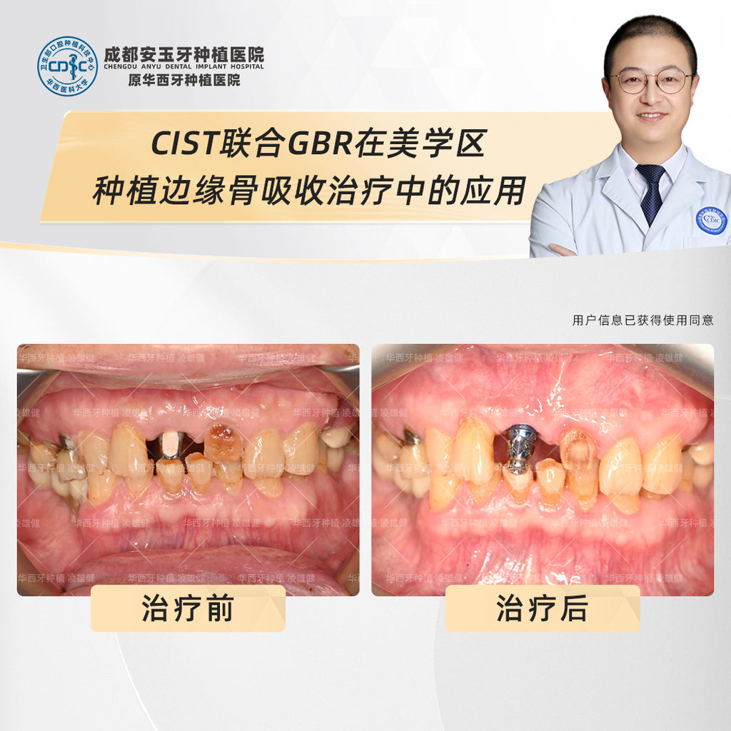 Dental Implants, Fixing Bone Loss with Deep Cleaning and Bone Grafting, Clinical Cases: Dr. Ling Xiongjian