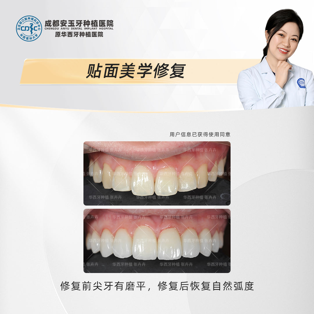 Dental Veneers: Aesthetic Rehabilitation for a Radiant Smile, Clinical Cases: Dr. Zhang Huihui
