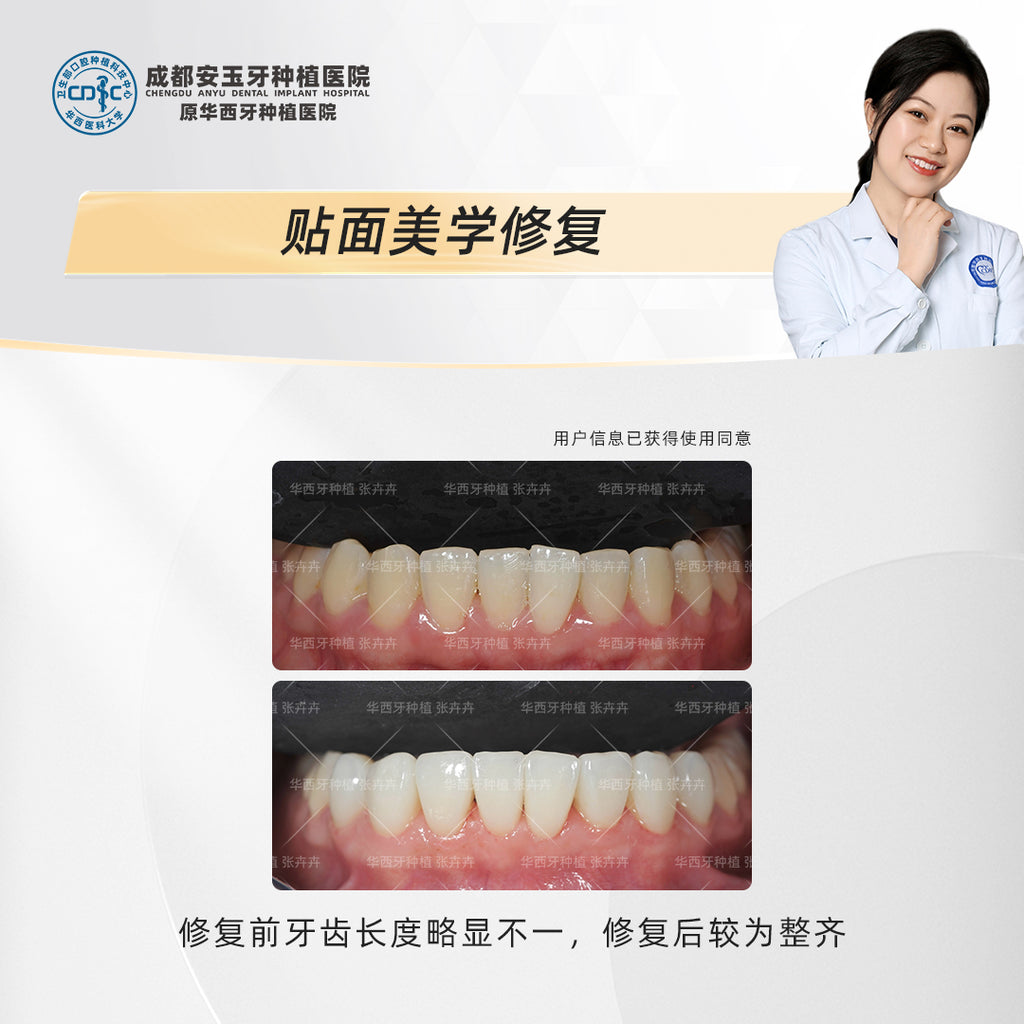 Dental Veneers: Aesthetic Rehabilitation for a Radiant Smile, Clinical Cases: Dr. Zhang Huihui