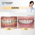 Dental Veneers, Aesthetic Rehabilitation – Revitalizing Smiles Stained by Smoking, Clinical Cases: Dr. Zhang Huihui