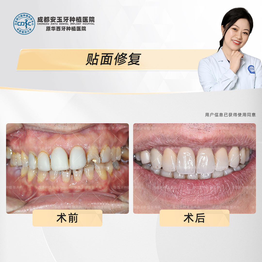 Dental Veneers, Aesthetic Rehabilitation – Revitalizing Smiles Stained by Smoking, Clinical Cases: Dr. Zhang Huihui