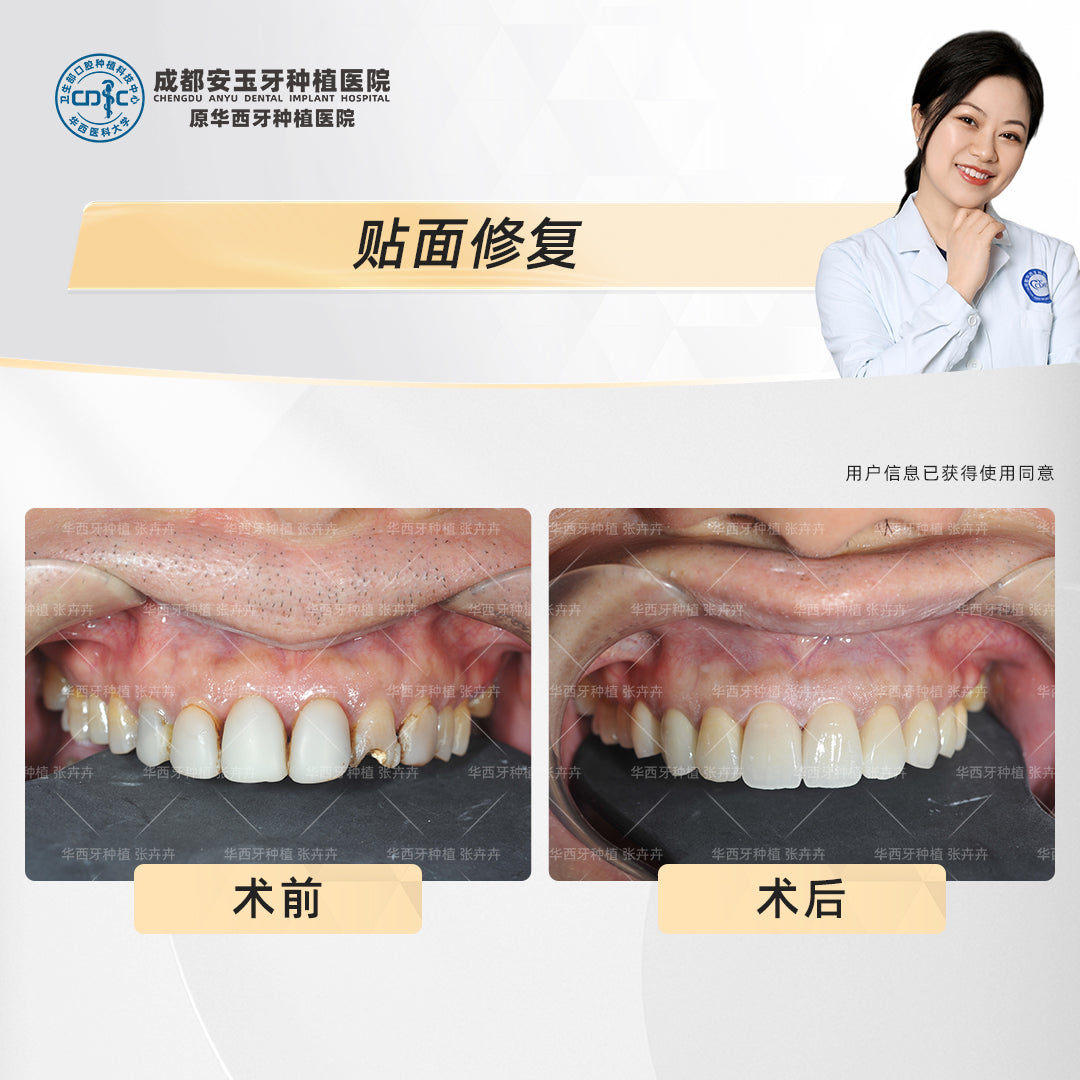 Dental Veneers, Aesthetic Rehabilitation – Revitalizing Smiles Stained by Smoking, Clinical Cases: Dr. Zhang Huihui
