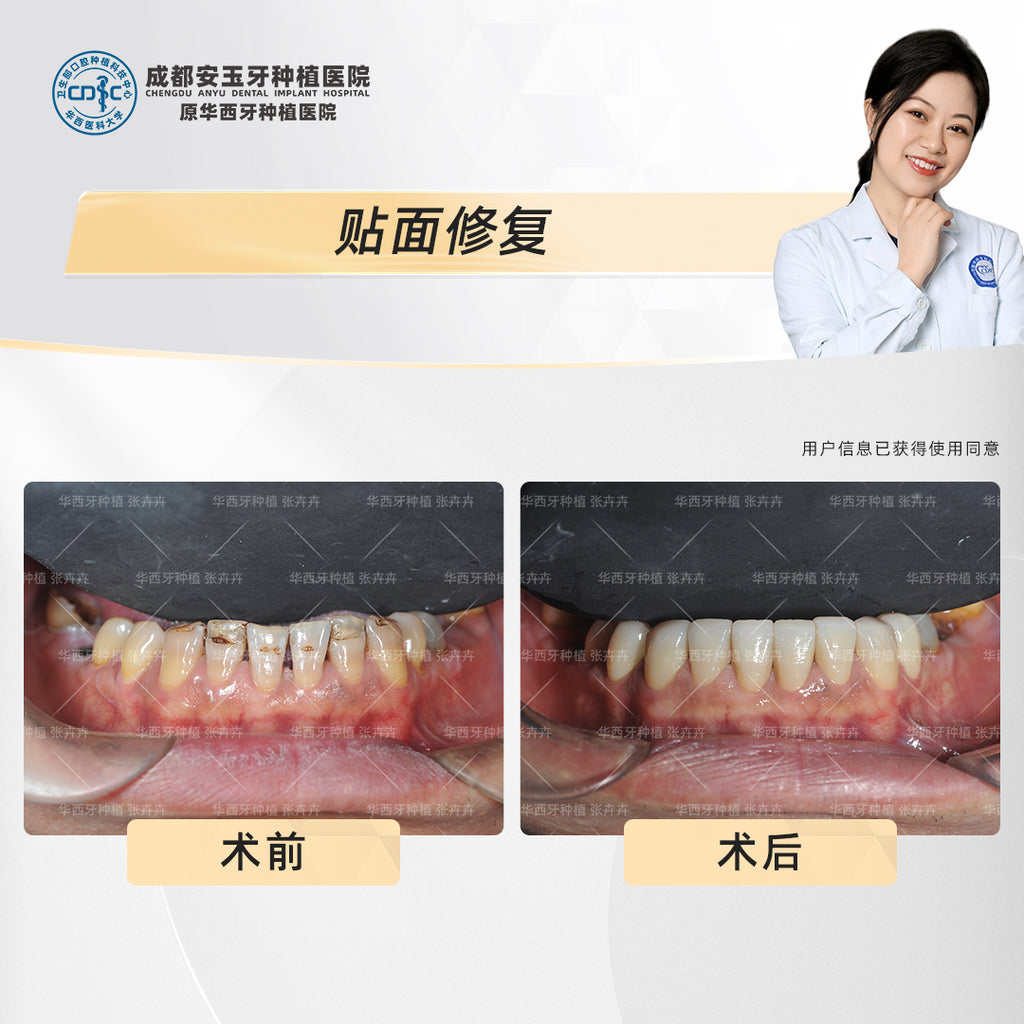 Dental Veneers, Aesthetic Rehabilitation – Revitalizing Smiles Stained by Smoking, Clinical Cases: Dr. Zhang Huihui