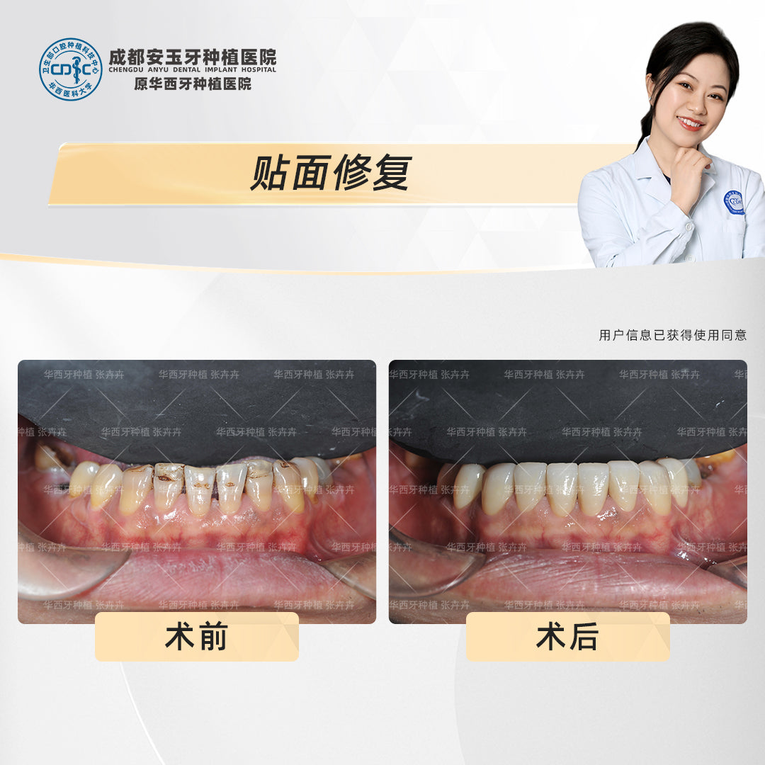 Dental Veneers, Aesthetic Rehabilitation – Revitalizing Smiles Stained by Smoking, Clinical Cases: Dr. Zhang Huihui