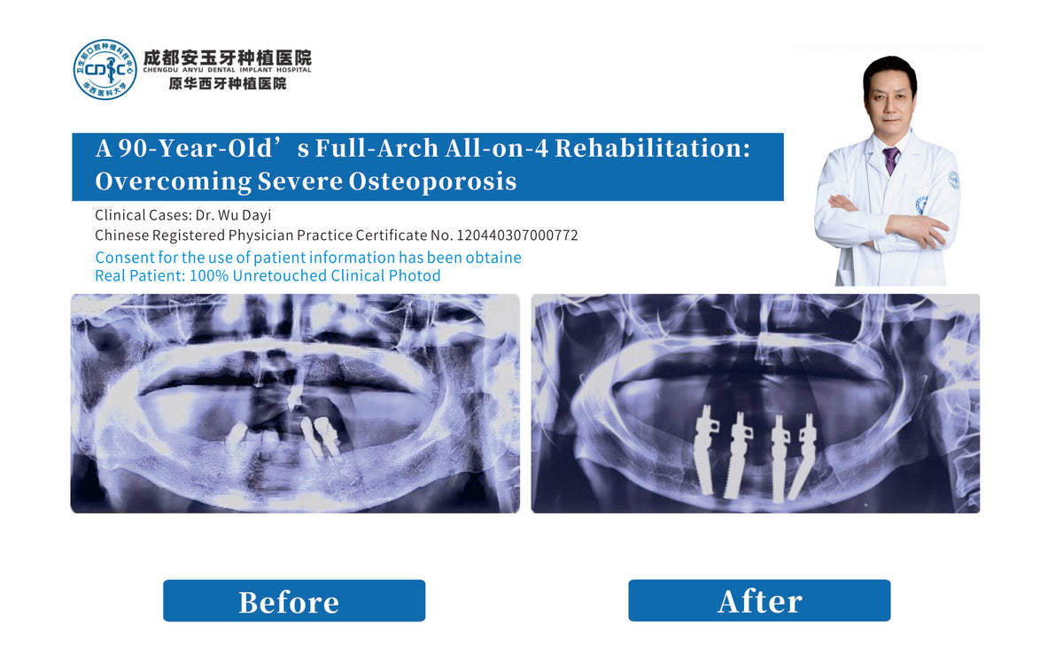 before ande afte CBCT , clinc case A 90-Year-Old’s Full-Arch All-on-4 Rehabilitation: Overcoming Severe Osteoporosis in chengdu anyu dental implant hospital, china, by Dr. Wu Dayi
