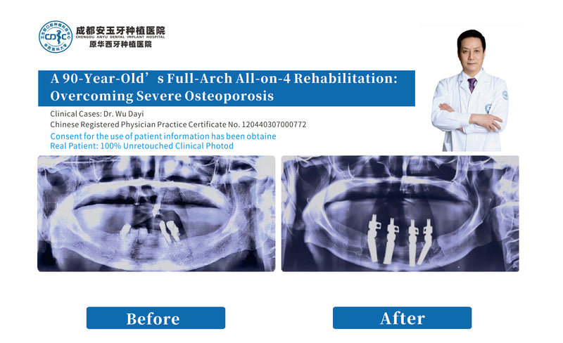 before ande afte CBCT , clinc case A 90-Year-Old’s Full-Arch All-on-4 Rehabilitation: Overcoming Severe Osteoporosis in chengdu anyu dental implant hospital, china, by Dr. Wu Dayi