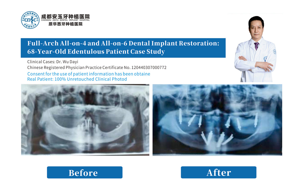 Full-Arch All-on-4 and All-on-6 Dental Implant Restoration: 68-Year-Old Edentulous Patient Case Study by China Chengdu anyu dental implant hospital dr wudayi