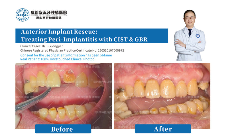 Advanced Peri-Implantitis Rescue & Bone Regeneration(CIST+GBR)
