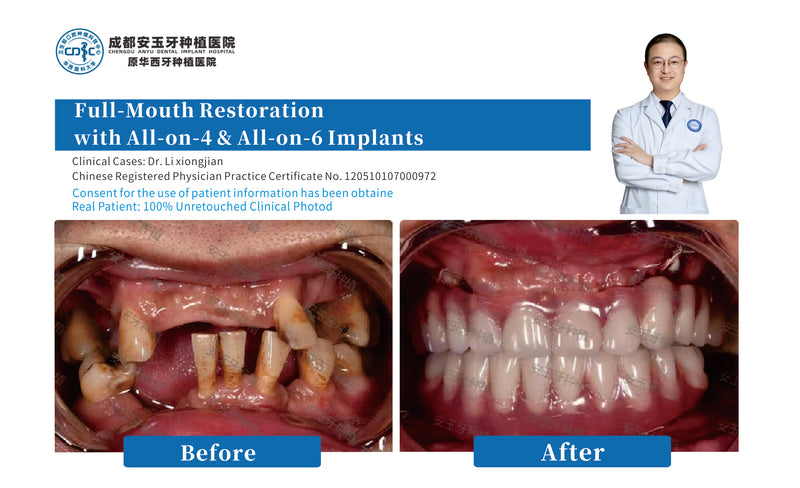 All-on-4 Full-Arch (Advanced Periodontitis Case)