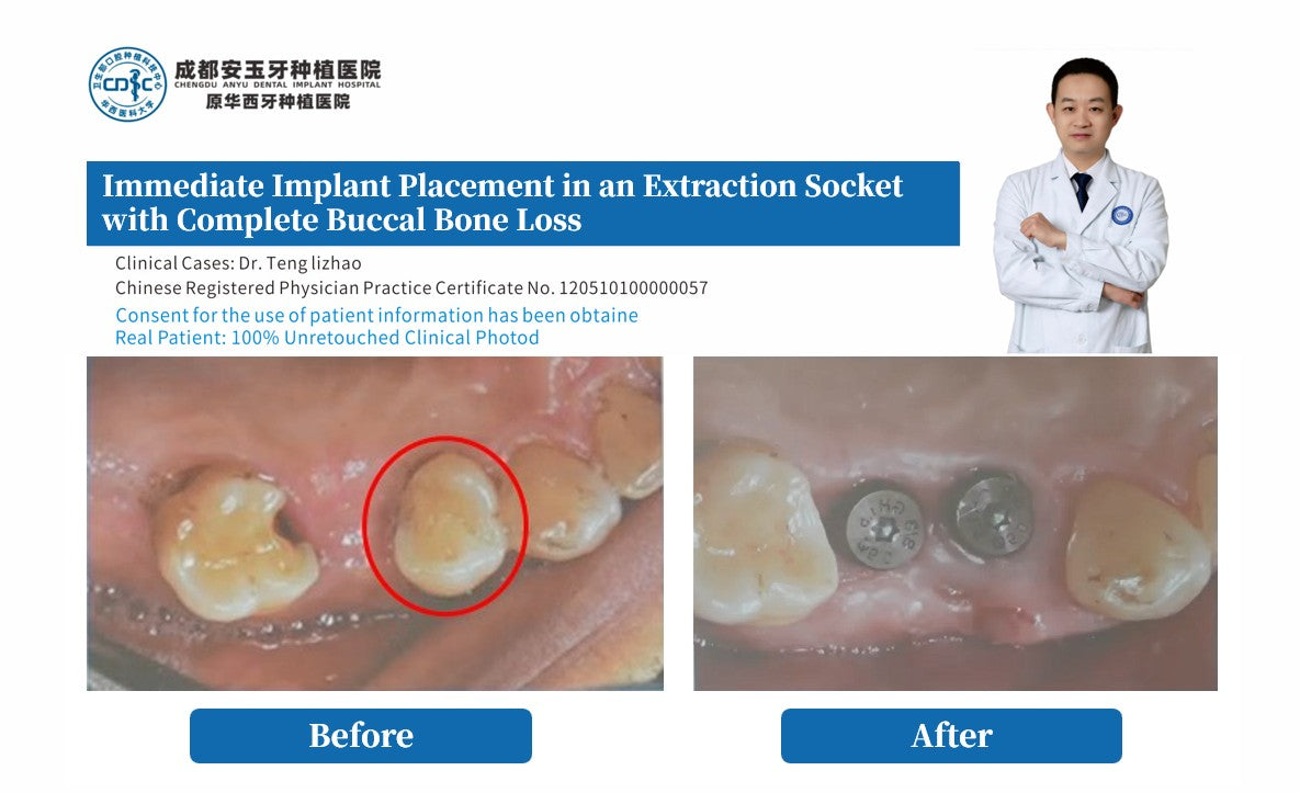 Before and after comparison photo showing Tooth 14 (FDI #14 / Universal #4) with severe mobility before extraction and successful immediate implant placement with healing abutment after surgery by Dr. Lizhao Teng.