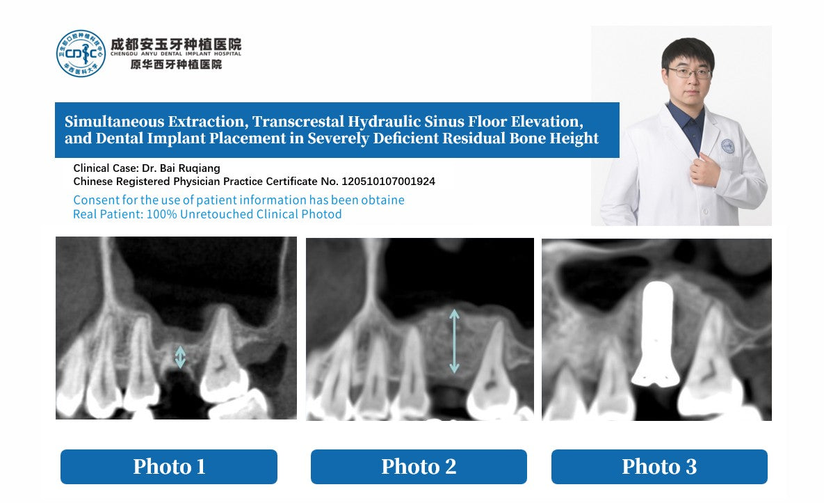 Before and after comparison photo showing Simultaneous Extraction, Transcrestal Hydraulic Sinus Floor Elevation, and Dental Implant Placement in Severely Deficient Residual Bone Height by Dr. Bai Ruqiang.