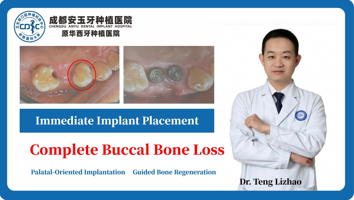 Video-Thumbnail-Case-Study-Presentation-Immediate-Implant-Placement-in-an-Extraction-Socket-with-Complete-Buccal_Bone-Loss-Dr-Tenglizhao-Anyu-Dental-Chengdu-China